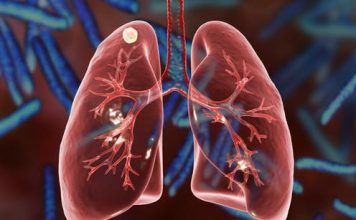 ТУБЕРКУЛЁЗ